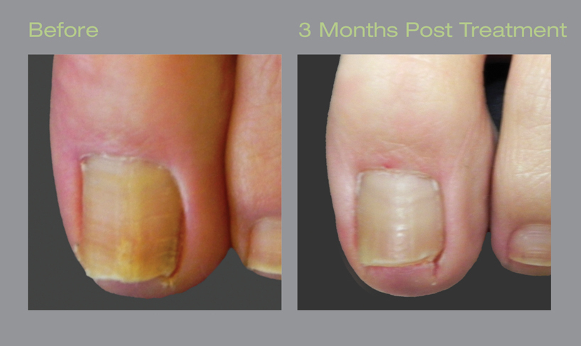 LASER TOENAIL FUNGUS TREATMENT 激光治疗灰趾甲 – Paincare Physio & Foot Clinic